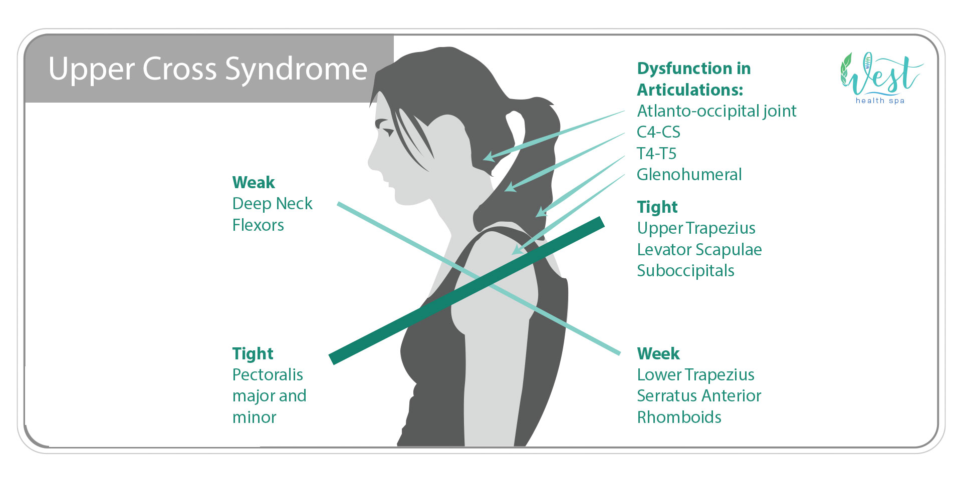 Upper Cross Syndrome